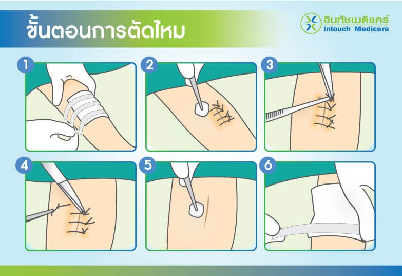 ขั้นตอนการตัดไหม