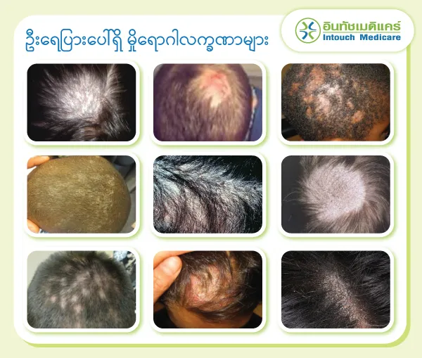 ဦးရေပြားပေါ်ရှိ မှိုရောဂါလက္ခဏာများ ဦးရေပြားပေါ်ရှိ မှိုရောဂါလက္ခဏာများ