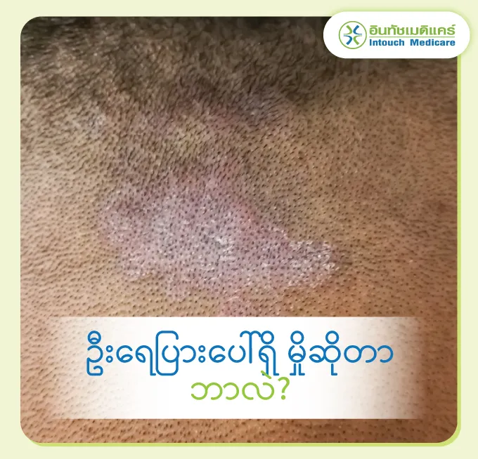 ဦးရေပြားမှာ မှိုဆိုတာ ဘာလဲ? ဦးရေပြားမှာ မှိုဆိုတာ ဘာလဲ?