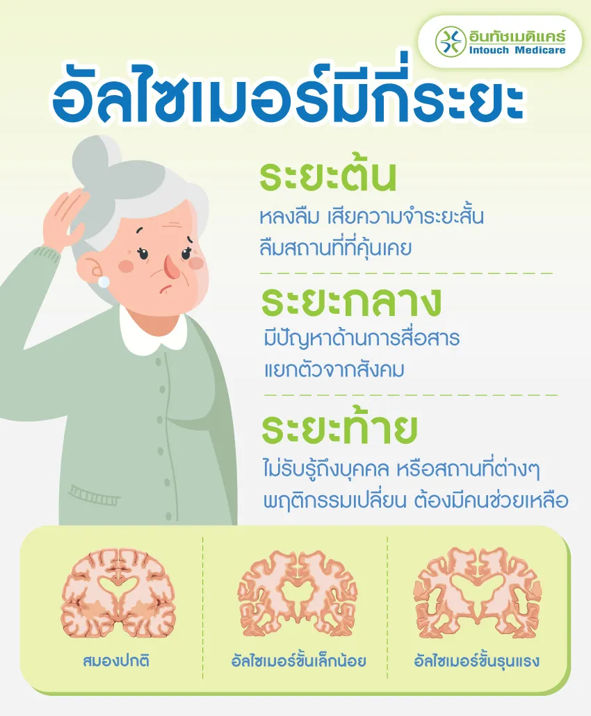 อัลไซเมอร์ มีกี่ระยะ  อัลไซเมอร์ มีกี่ระยะ