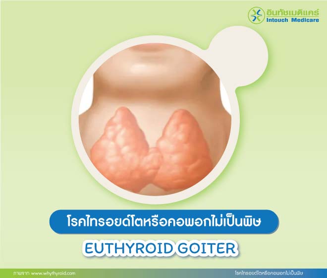 โรคไทรอยด์โตหรือคอพอกไม่เป็นพิษ โรคไทรอยด์โตหรือคอพอกไม่เป็นพิษ