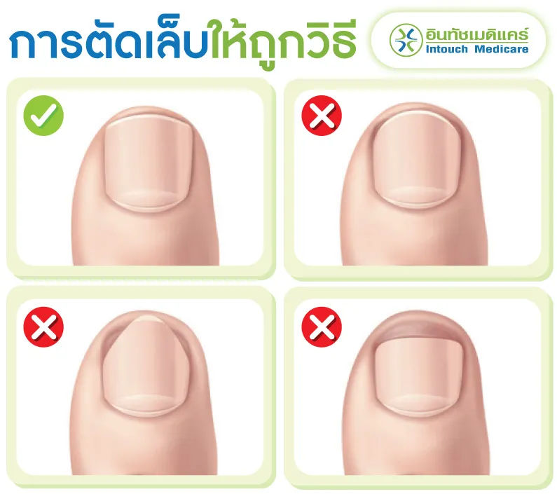 การตัดเล็บให้ถูกวิธี