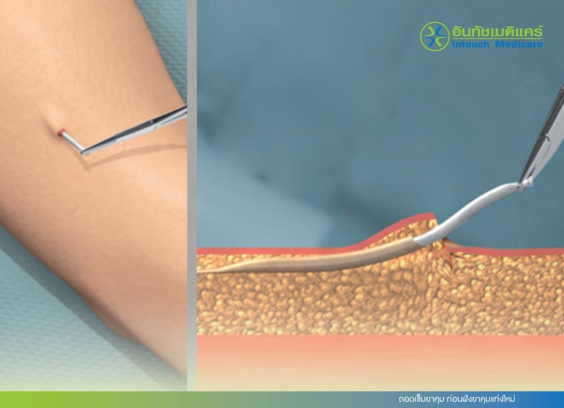 ถอดเข็มยาคุม ก่อนฝังยาคุมแท่งใหม่ ถอดเข็มยาคุม ก่อนฝังยาคุมแท่งใหม่