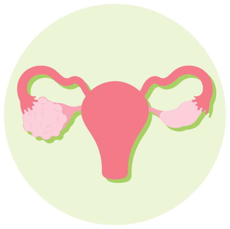 ตรวจคัดกรองถุงน้ำรังไข่หลายใบ PCOS ตรวจคัดกรองถุงน้ำรังไข่หลายใบ PCOS