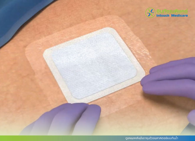 ดูแลแผลหลังฝังยาคุมด้วยพลาสเตอร์แบบกันน้ำ ดูแลแผลหลังฝังยาคุมด้วยพลาสเตอร์แบบกันน้ำ