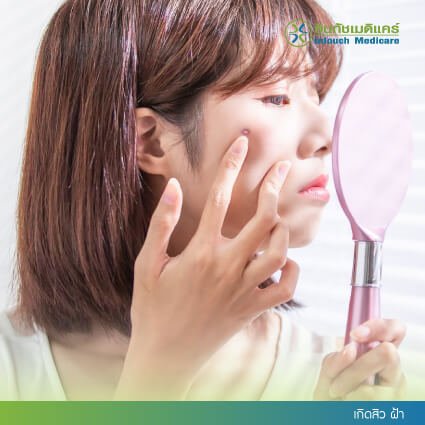 เกิดสิว ฝ้า เกิดสิว ฝ้า