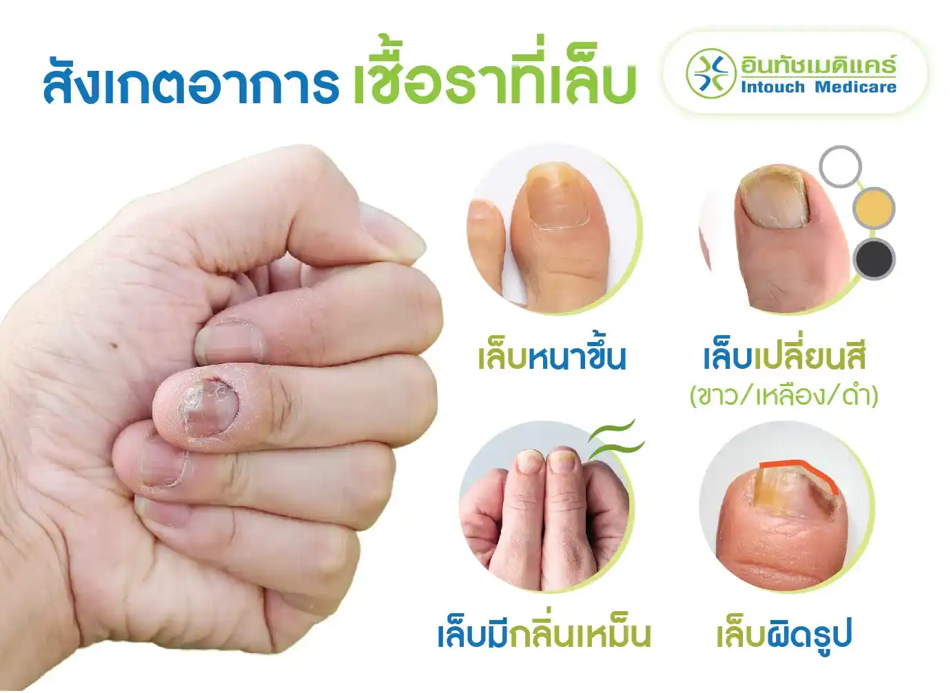 วิธีสังเกตอาการของเชื้อราที่เล็บ