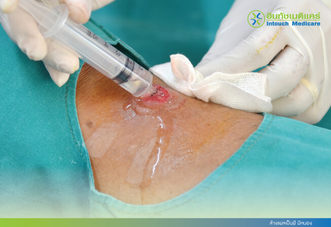 Clean the wound with abscess and pus Clean the wound with abscess and pus