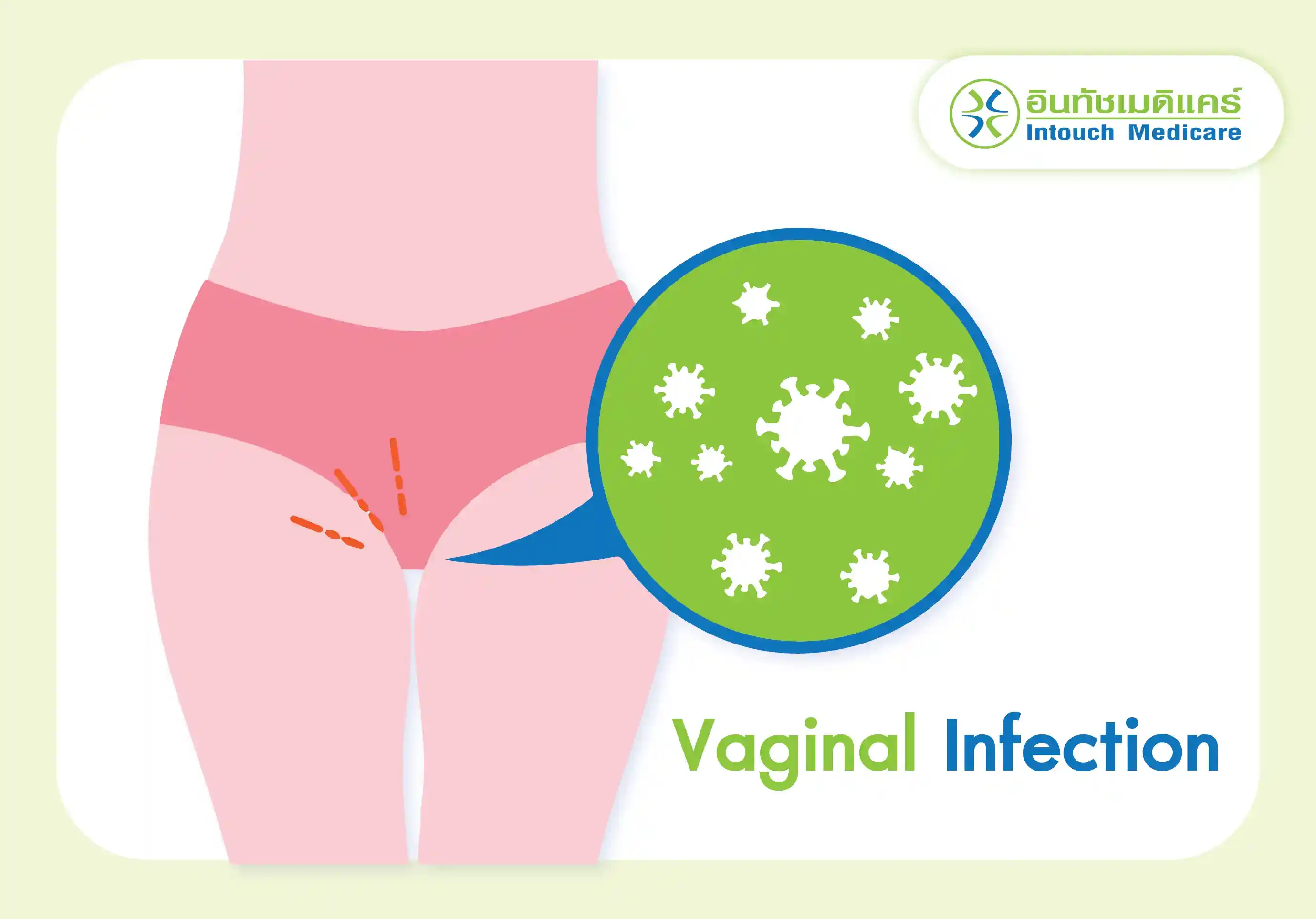 vaginal_infection vaginal_infection