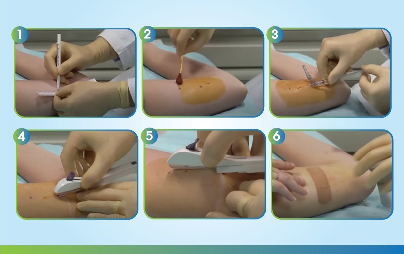 ฝังยาคุมกำเนิด ขั้นตอนการฝังยาคุม